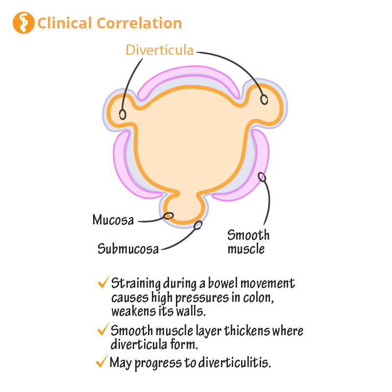 Diverticulosis